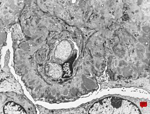 M,68y. | membranous glomerulopathy - late stage M,68y. | membranous glomerulopathy - late stage